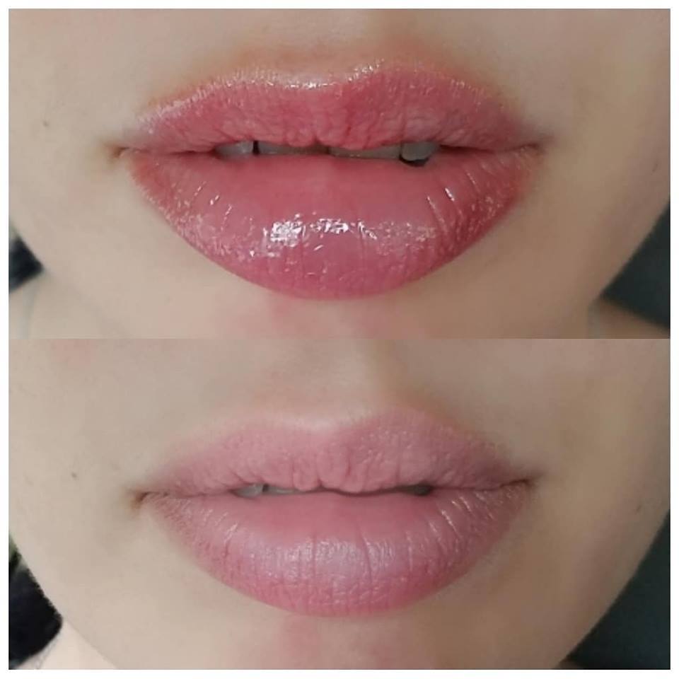 lip augmentation products