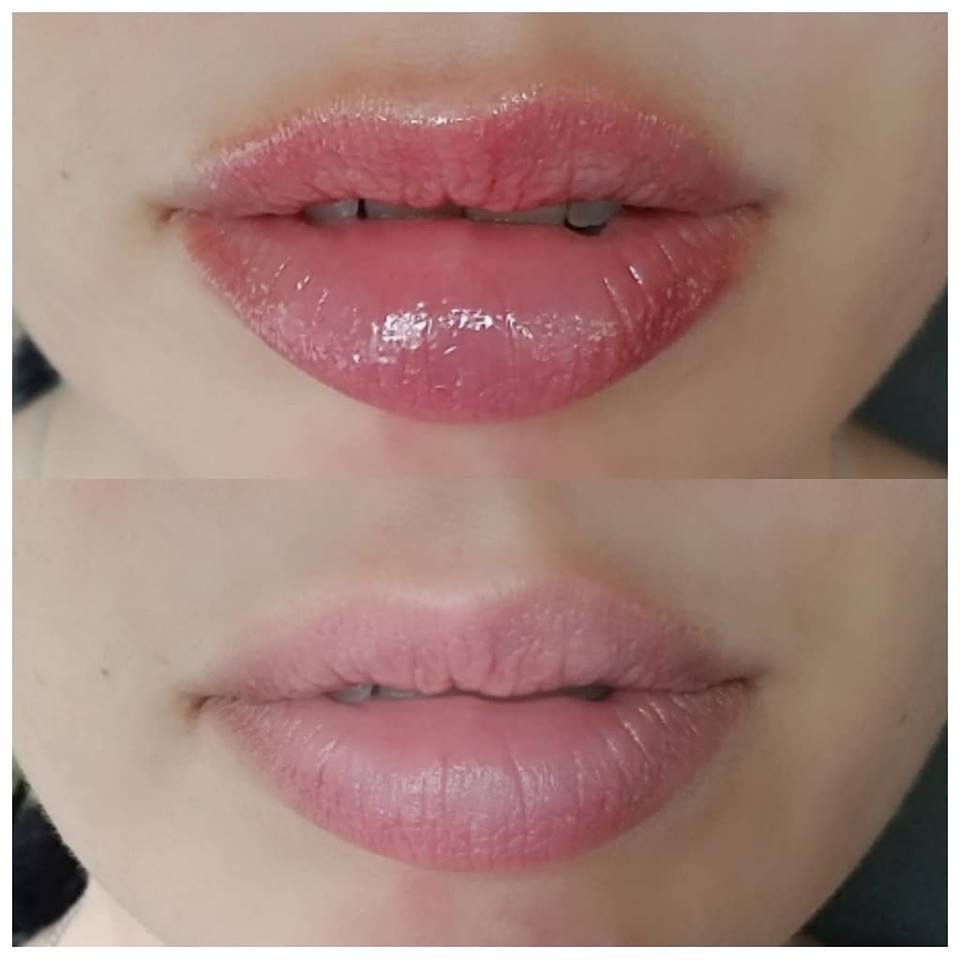 dermarolling lips