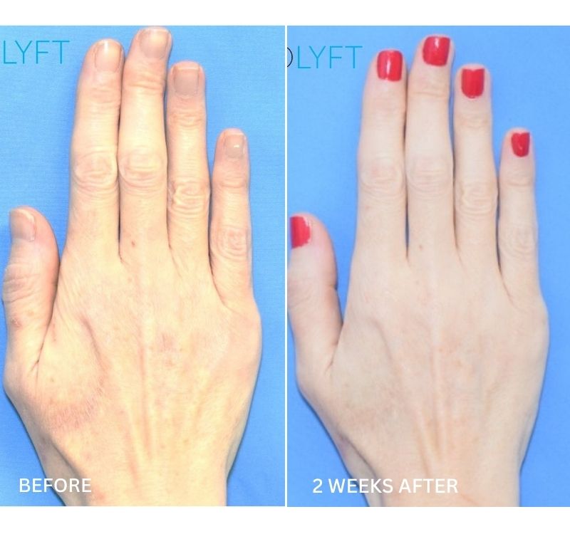 MesoLyft Rejuvenating Gloves