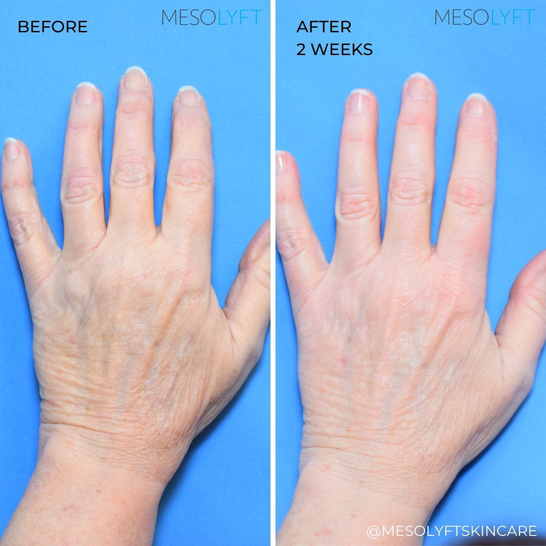 MesoLyft Rejuvenating Gloves