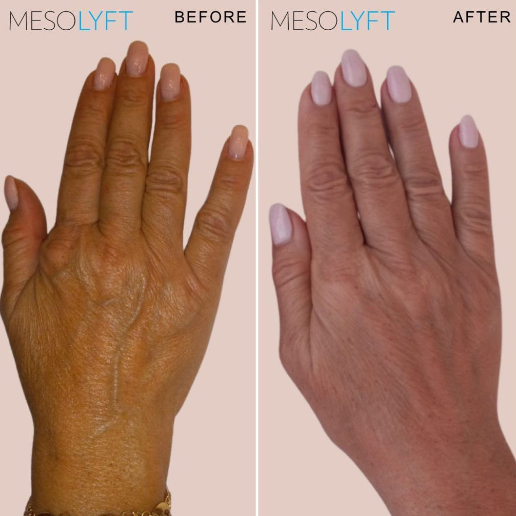 MesoLyft Rejuvenating Gloves